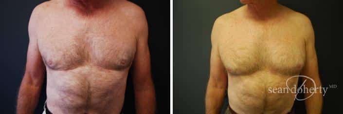 Patient 2562, Liposuction Before and After Photos Liposuction Before and After Photos in Boston, MA, Patient 2562