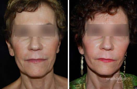 Patient 3227, Facelift Before and After Photos Facelift Before and After Photos in Boston, MA, Patient 3227