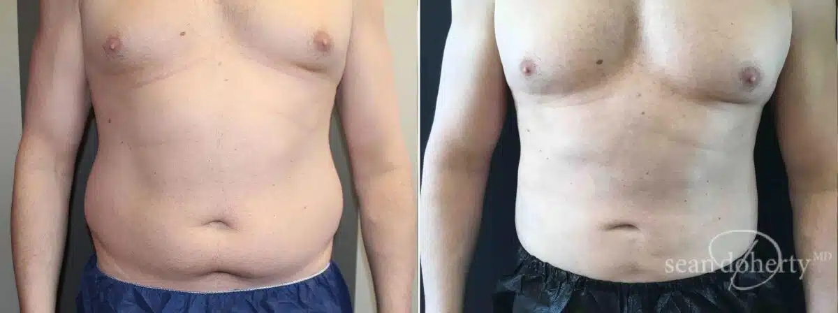 Liposuction Before and After Photos in Boston, MA, Patient 3351