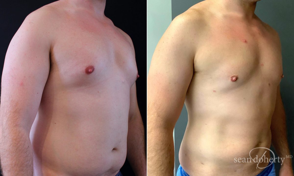 Liposuction Before and After Photos in Boston, MA, Patient 5039