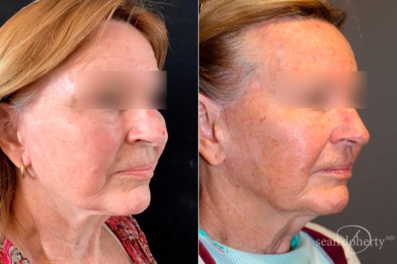 Facelift Before and After Photos in Boston, MA, Patient 5087