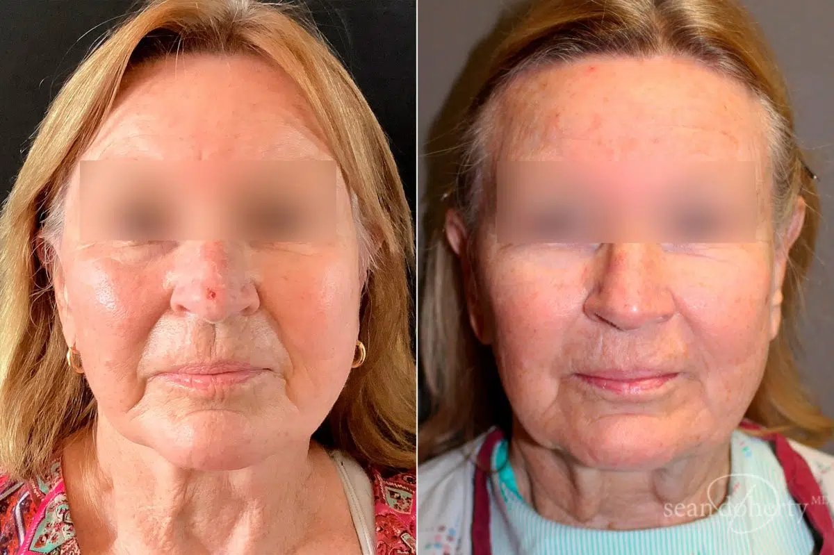 Facelift Before and After Photos in Boston, MA, Patient 5087