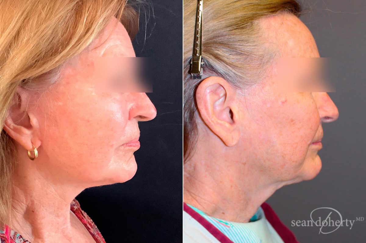 Facelift Before and After Photos in Boston, MA, Patient 5087