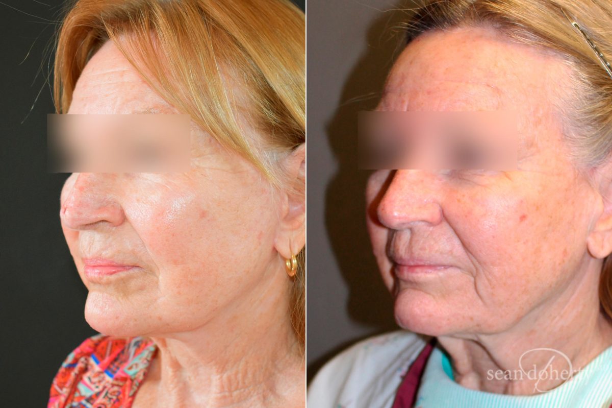 Facelift Before and After Photos in Boston, MA, Patient 5087