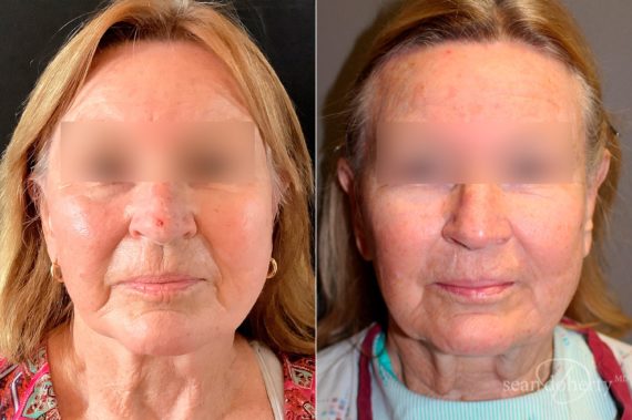 Facelift Before and After Photos in Boston, MA