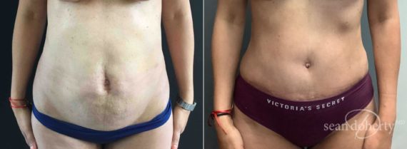 Tummy Tuck Before and After Photos in Boston, MA, Patient 6545