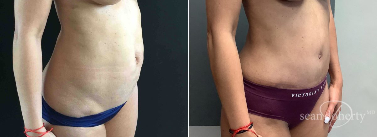 Tummy Tuck Before and After Photos in Boston, MA, Patient 6545