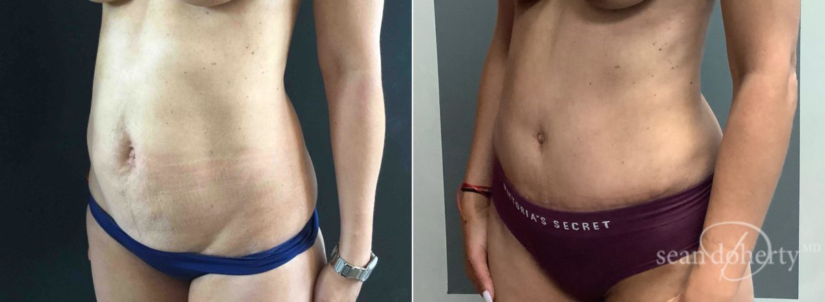 Tummy Tuck Before and After Photos in Boston, MA, Patient 6545