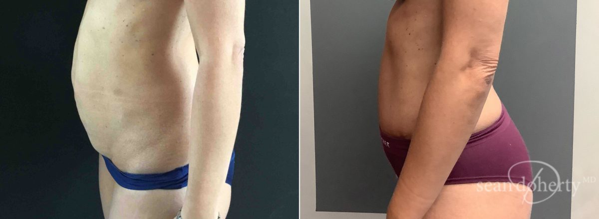 Patient 6545, Tummy Tuck Before and After Photos Tummy Tuck Before and After Photos in Boston, MA, Patient 6545