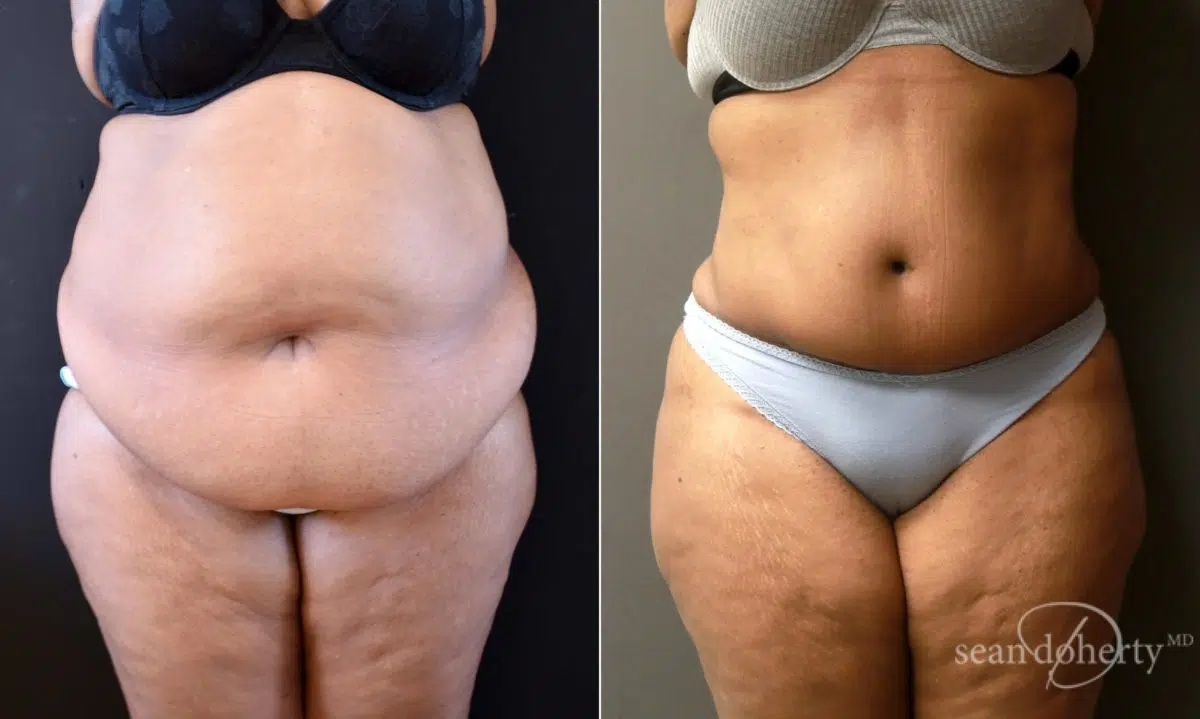 Tummy Tuck (Abdominoplasty), Woman - Age 40 - Before & After Photos