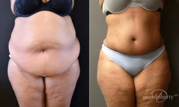 Tummy Tuck Before and After Photos in Boston, MA