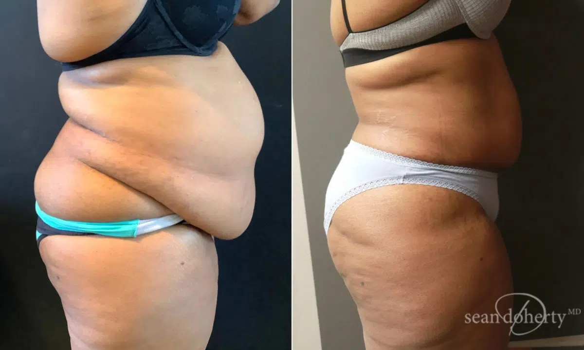 Tummy Tuck Before and After Photos in Boston, MA, Patient 6553