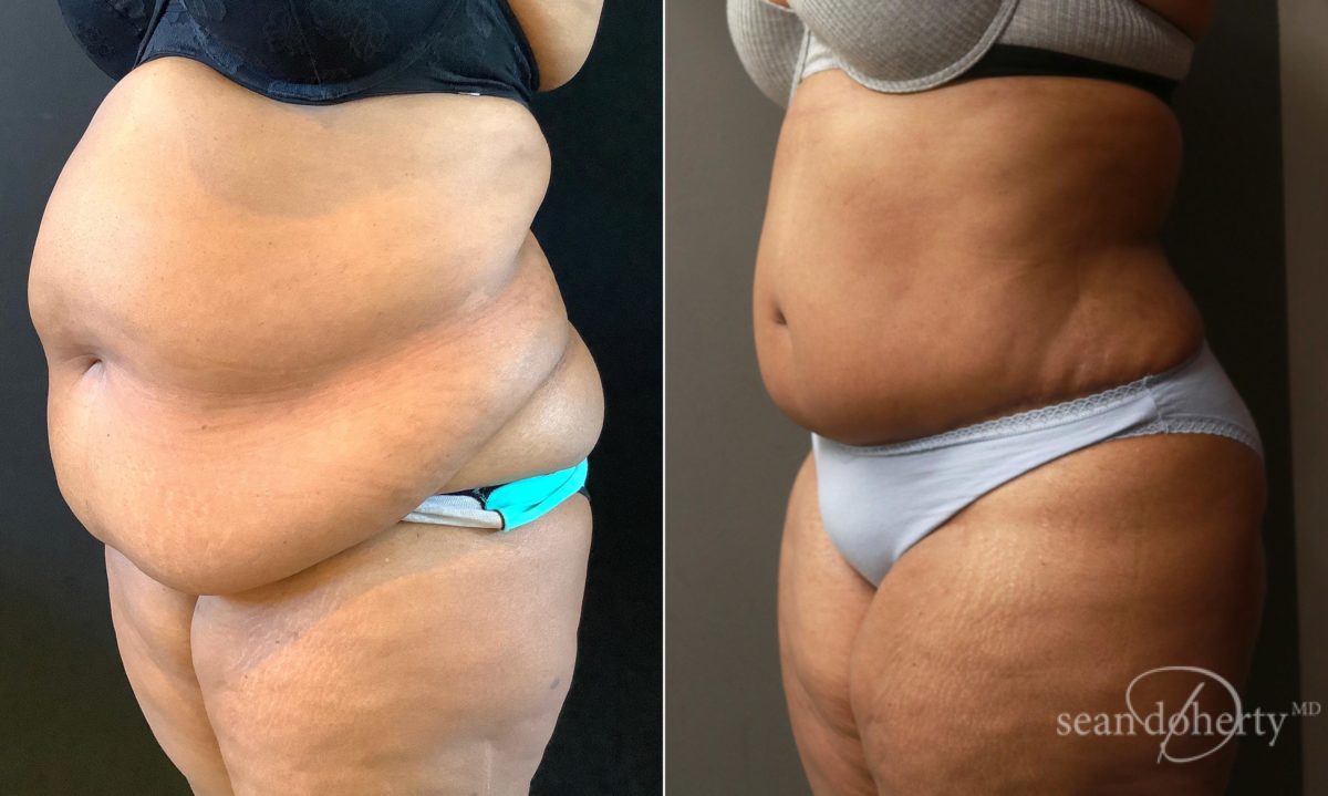 Tummy Tuck Before and After Photos in Boston, MA, Patient 6553