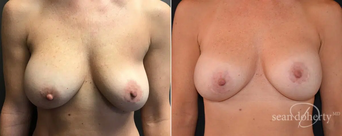 Breast Implant Exchange Before and After Photos in Boston, MA, Patient 6564