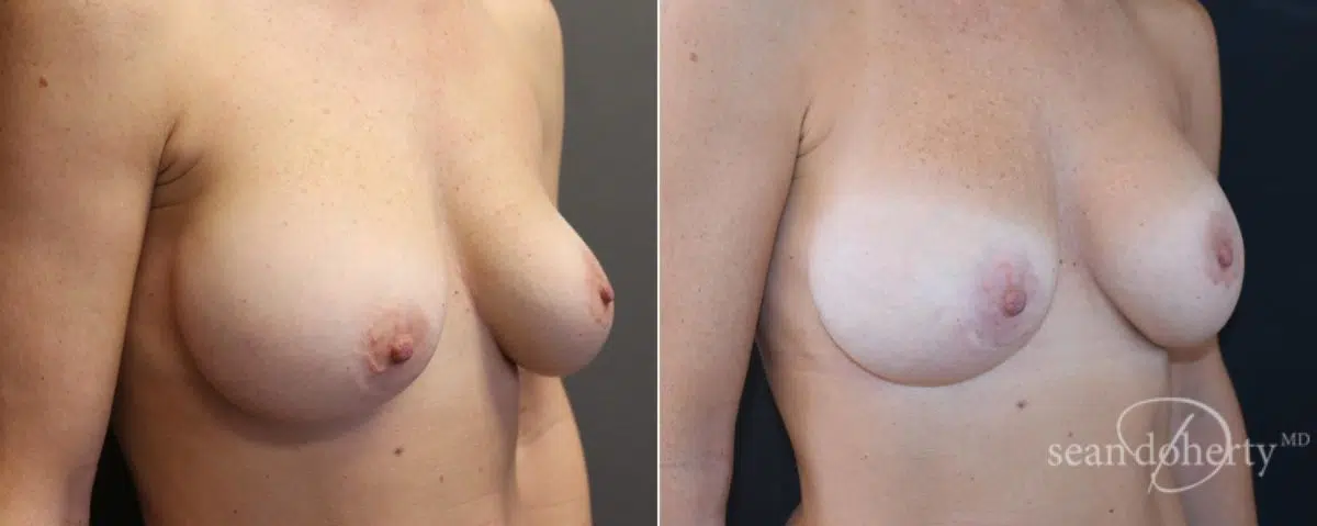 Breast Implant Exchange Before and After Photos in Boston, MA, Patient 6564