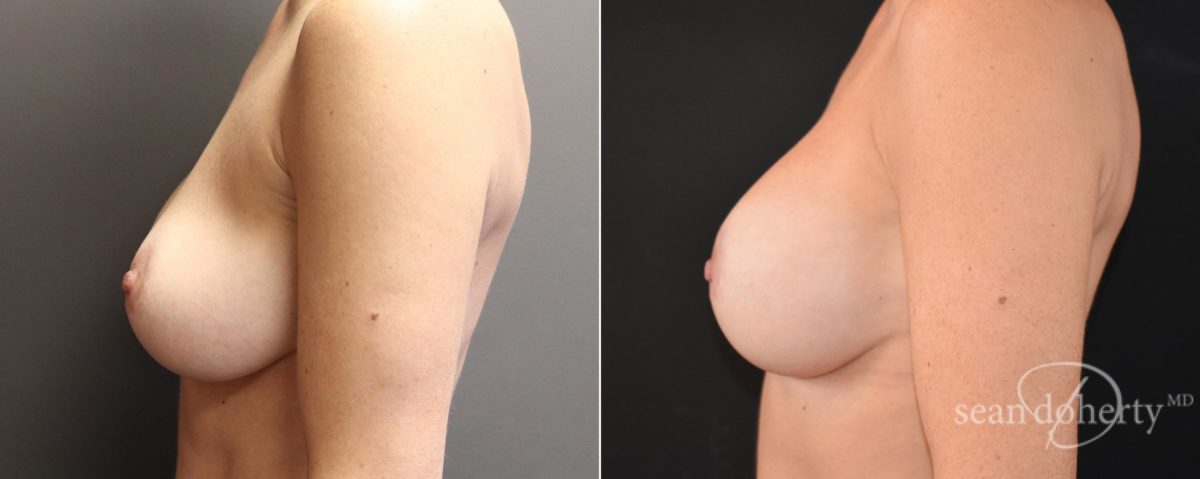 Breast Implant Exchange Before and After Photos in Boston, MA, Patient 6564