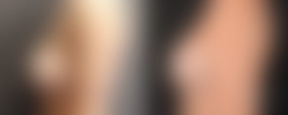 Breast Implant Exchange Before and After Photos in Boston, MA, Patient 6564