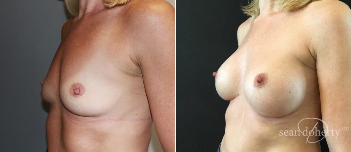 Breast Augmentation Before and After Photos in Boston, MA, Patient 6567