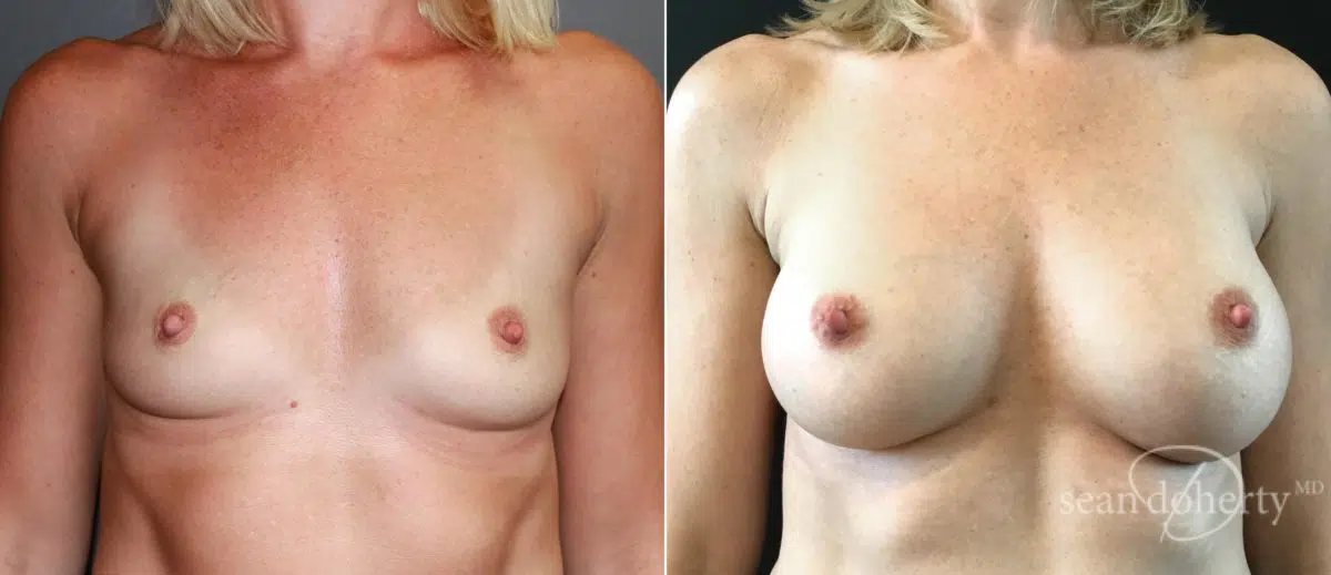 Breast Augmentation Before and After Photos in Boston, MA, Patient 6567