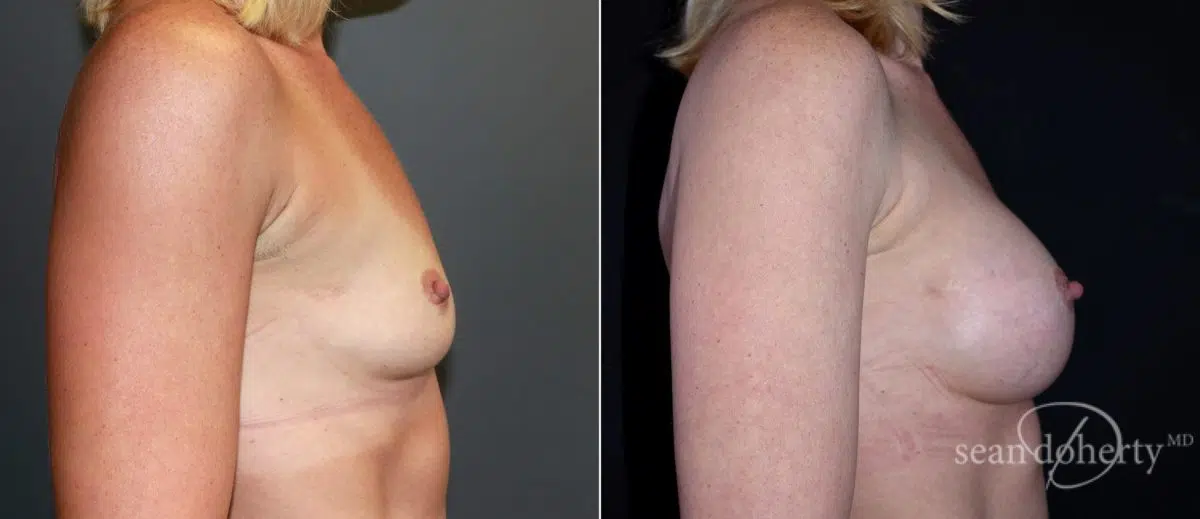 Breast Augmentation Before and After Photos in Boston, MA, Patient 6567