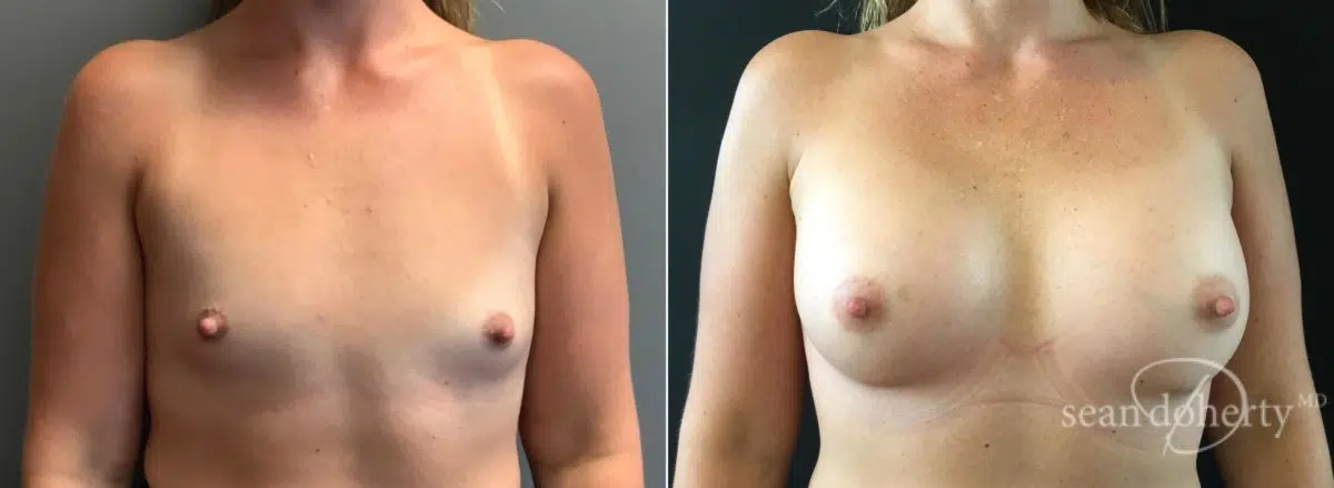 Breast Augmentation Before and After Photos in Boston, MA, Patient 6568