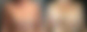 Breast Augmentation Before and After Photos in Boston, MA, Patient 6568