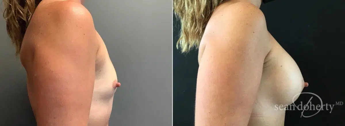 Breast Augmentation Before and After Photos in Boston, MA, Patient 6568