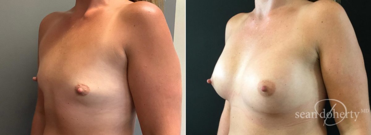 Breast Augmentation Before and After Photos in Boston, MA, Patient 6568