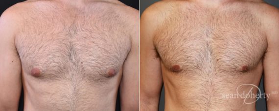 Gynecomastia Before and After Photos in Boston, MA, Patient 6612