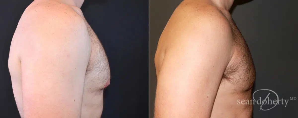 Gynecomastia Before and After Photos in Boston, MA, Patient 6612