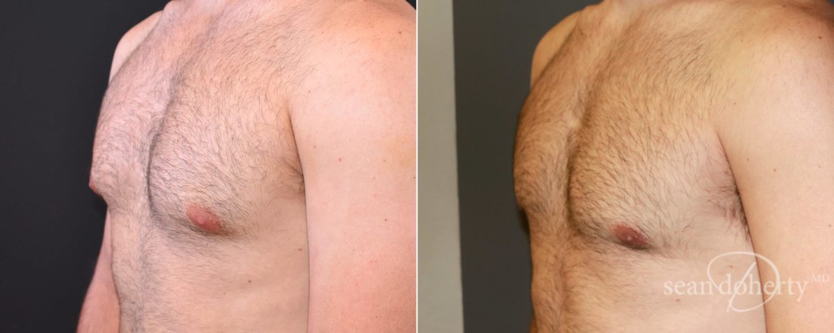 Gynecomastia Before and After Photos in Boston, MA, Patient 6612