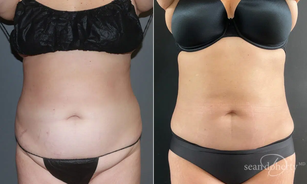 Liposuction Before and After Photos in Boston, MA, Patient 6701