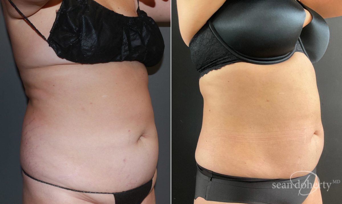 Liposuction Before and After Photos in Boston, MA, Patient 6701