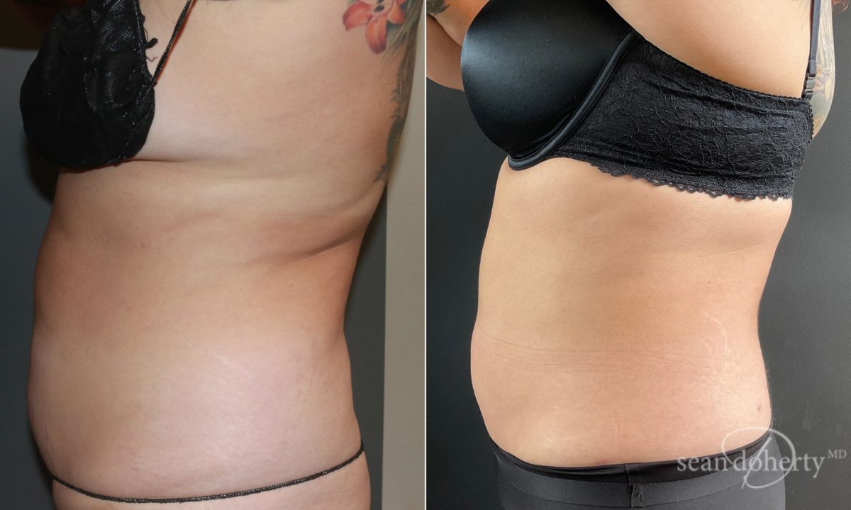 Liposuction Before and After Photos in Boston, MA, Patient 6701