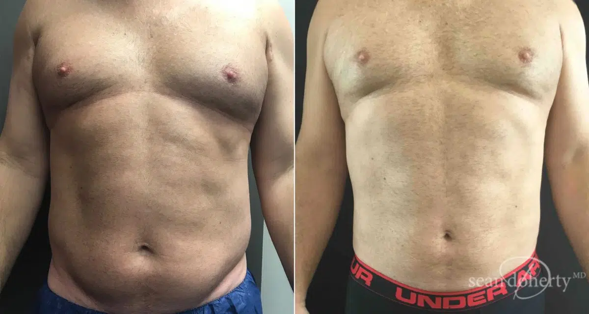 Liposuction Before and After Photos in Boston, MA, Patient 6721