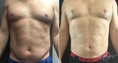 Liposuction Before and After Photos in Boston, MA, Patient 6721