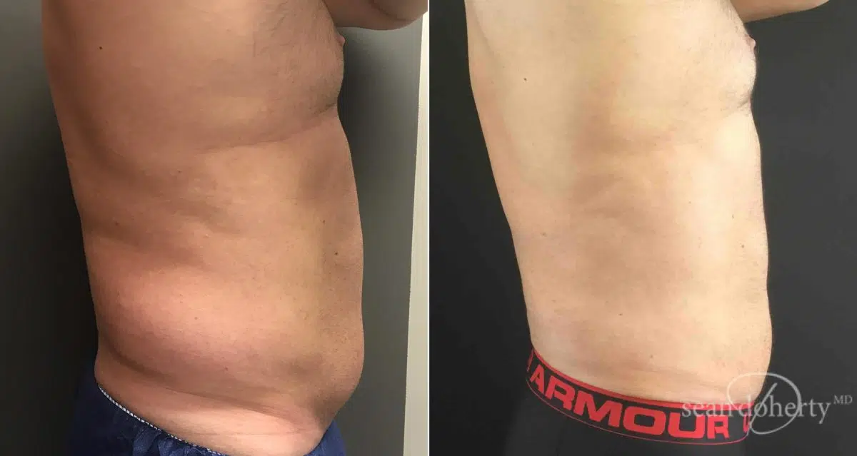 Liposuction Before and After Photos in Boston, MA, Patient 6721