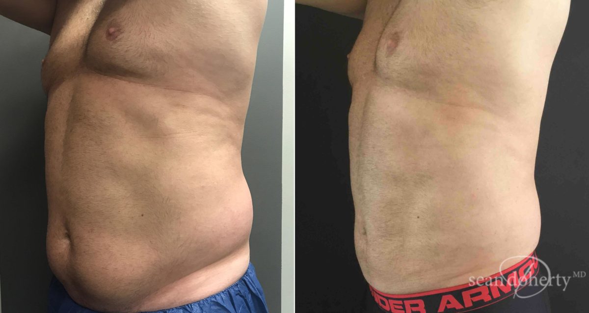 Liposuction Before and After Photos in Boston, MA, Patient 6721