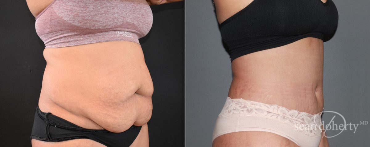 Tummy Tuck Before and After Photos in Boston, MA, Patient 6723