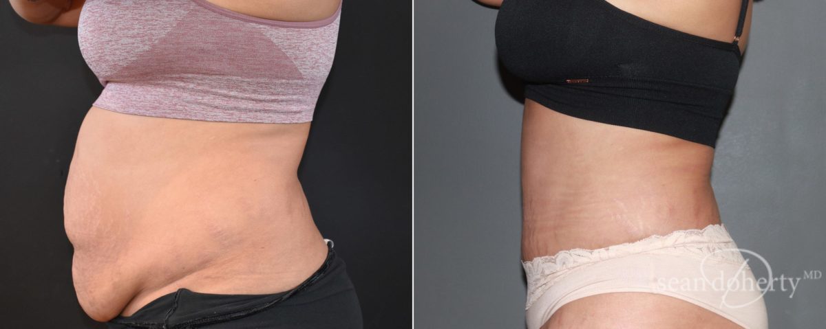 Tummy Tuck Before and After Photos in Boston, MA, Patient 6723