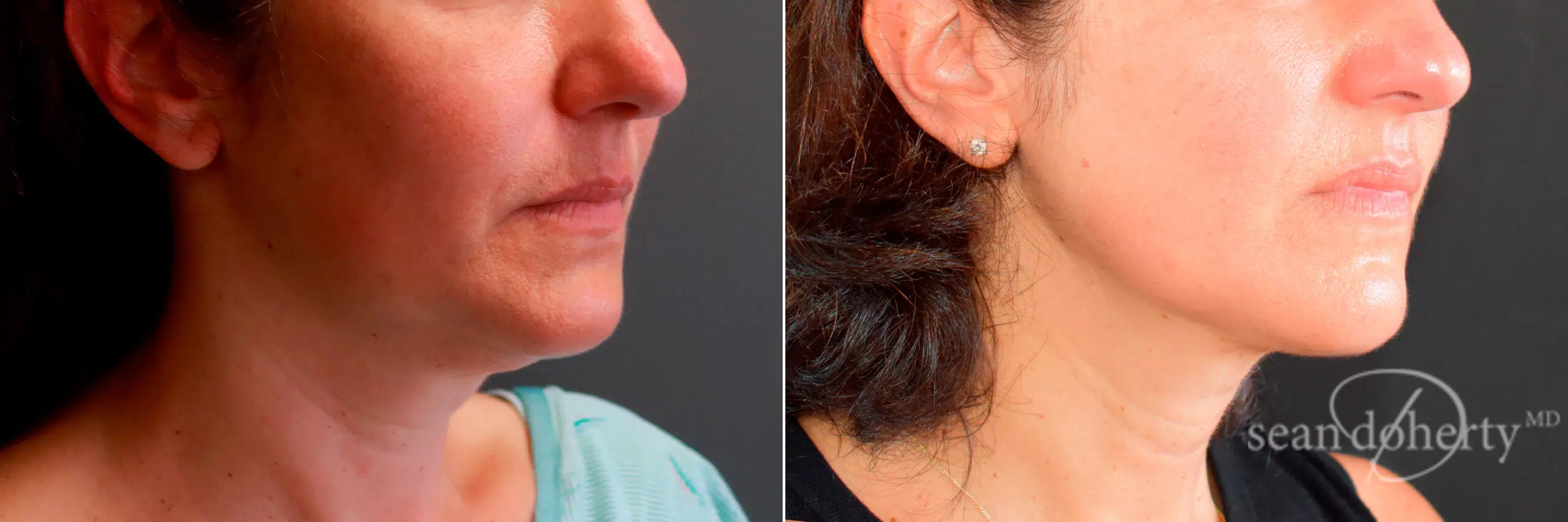 Facial Thread Lift Boston, MA,  Before and After Photos Liposuction Before and After Photos in Boston, MA, Patient 5820