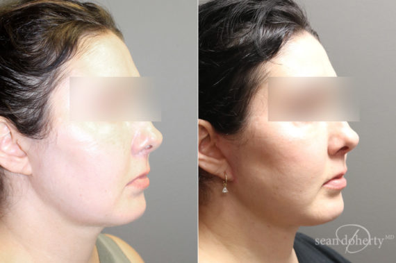 Facelift Before and After Photos in Boston, MA, Patient 6565