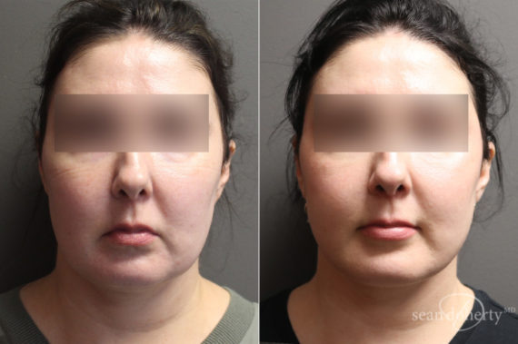 Facelift Before and After Photos in Boston, MA, Patient 6565