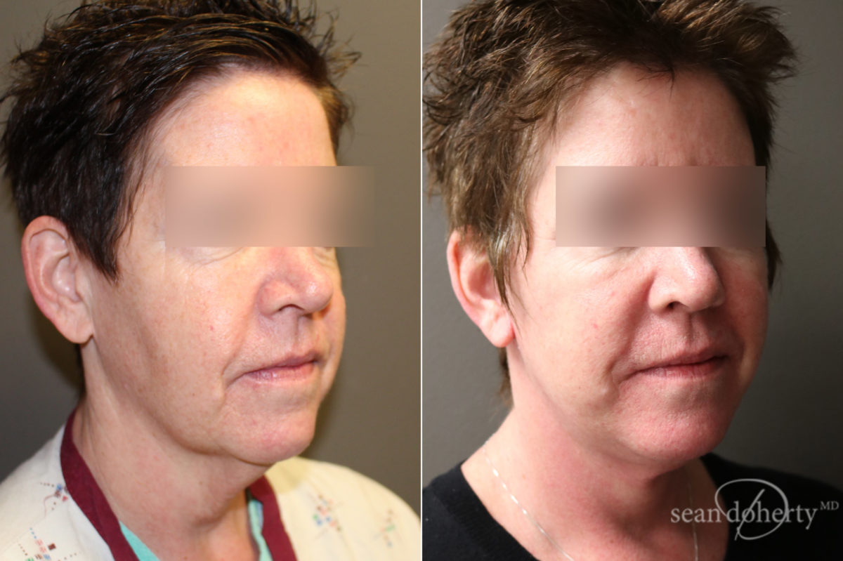 Facelift Before and After Photos in Boston, MA, Patient 6611