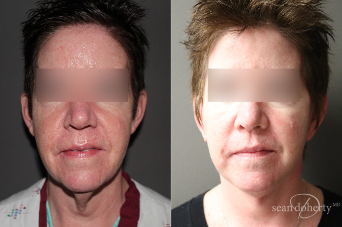 Facelift Before and After Photos in Boston, MA, Patient 6611