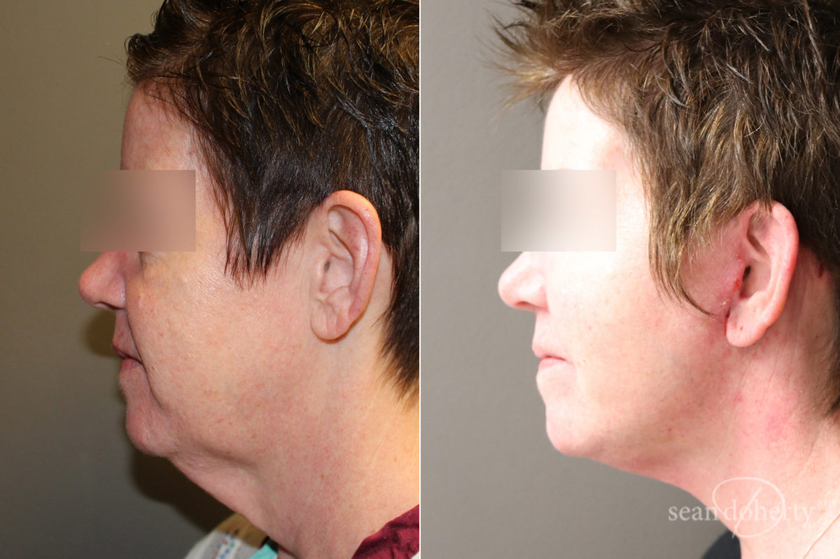 Patient 6611, Facelift Before and After Photos Facelift Before and After Photos in Boston, MA, Patient 6611