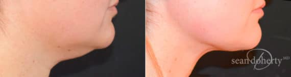 Liposuction Before and After Photos in Boston, MA, Patient 6722