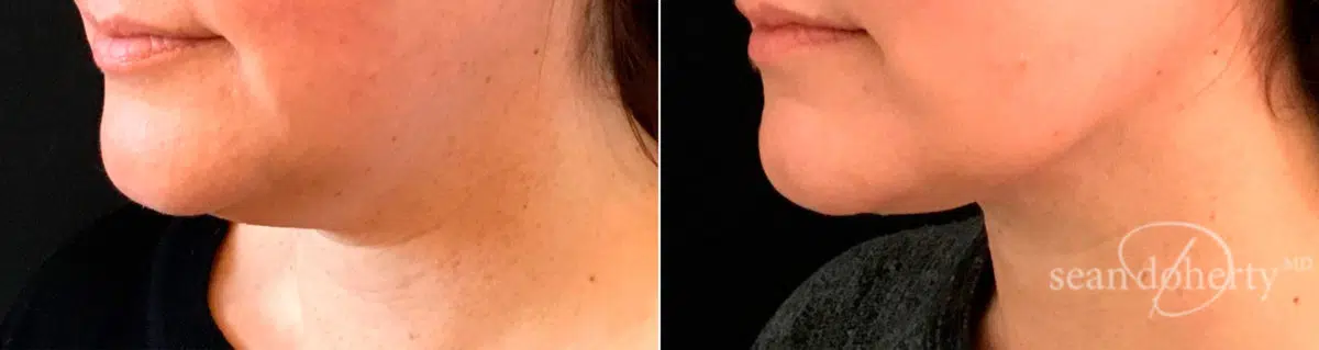 Patient 6722, Liposuction Before and After Photos Liposuction Before and After Photos in Boston, MA, Patient 6722