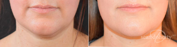 Neck Liposuction Before and After Photos in Boston, MA