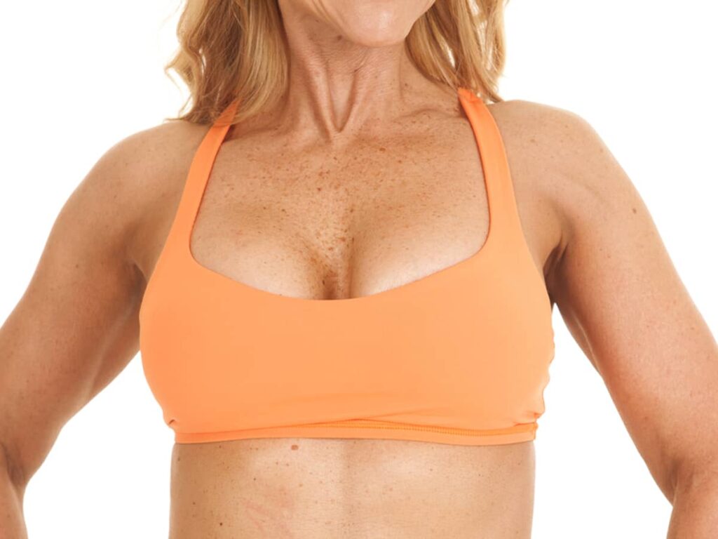 Mastopexy augmentation and fat grafting are two types of breast lift procedures that can reduce the saggy appearance of breasts and restore volume to create a youthful look.